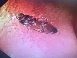 Man Complaining of Indigestion Had Live Cockroach in His Intestines